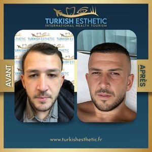 Résultat Greffe de cheveux Naturelle Turquie