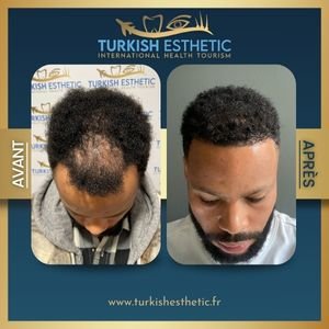 Résultat avant et après une greffe capillaire FUE pour cheveux afro réalisée chez Turkish Esthetic à Istanbul.