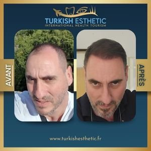 Résultat avant et après une greffe capillaire FUE réalisée à Istanbul avec la méthode saphir.