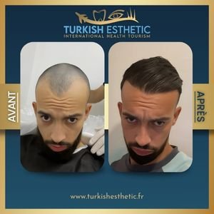 Avant et après une greffe de cheveux a istanbul réalisée par Turkish Esthetic à Istanbul, montrant une transformation capillaire naturelle et réussie.