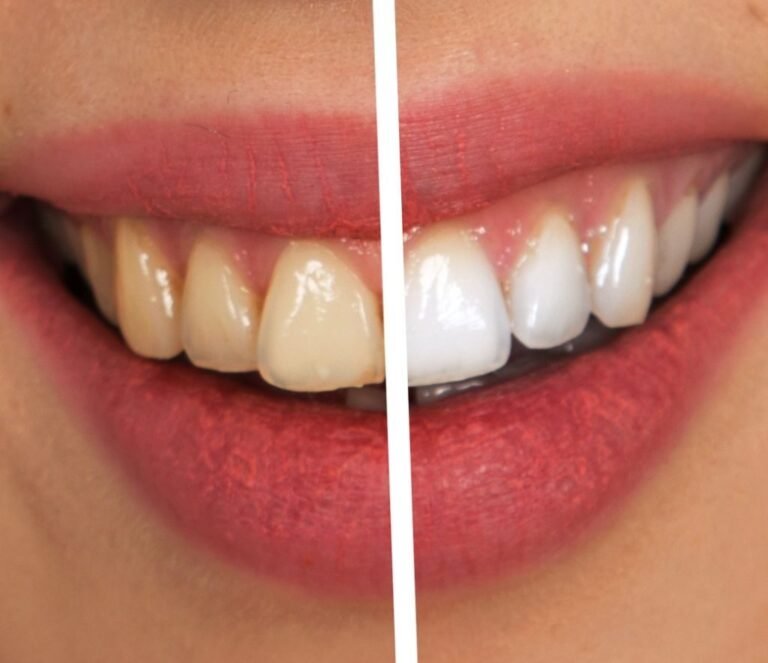 Comparaison avant/après montrant le changement visible de la teinte des dents suite à un traitement dentaire en Turquie.