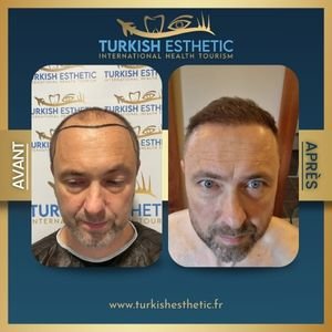 Patient français avant après greffe de cheveux