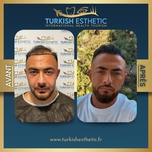 Resultat implantation capillaire turquie ligne frontale