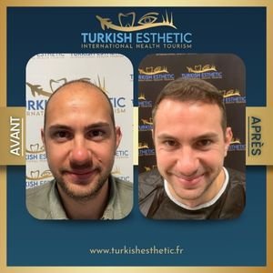 Résultat avant et après une greffe capillaire réalisée à Istanbul