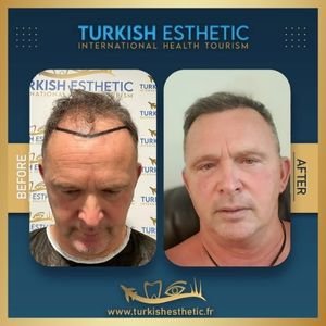 Résultat implant capillaire Fue saphir