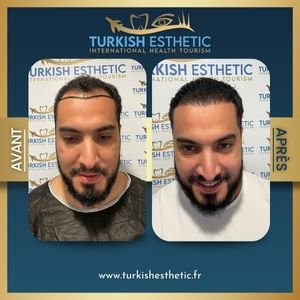 Avant‑après greffe de cheveux DHI Robotic à la clinique Turkish Esthetic : ligne frontale restaurée et densité naturelle.