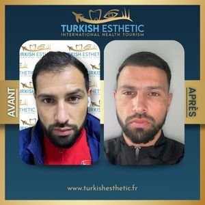 Résultat greffe de cheveux en turquie (Dhi robotic)