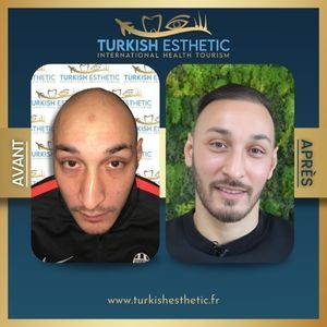 Avant et après une greffe de cheveux en Turquie réalisée chez Turkish Esthetic, montrant des résultats naturels et impressionnants.