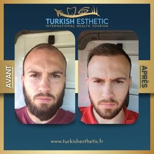 Avant et après une greffe capillaire en Turquie chez Turkish Esthetic, montrant une densité capillaire restaurée et naturelle.