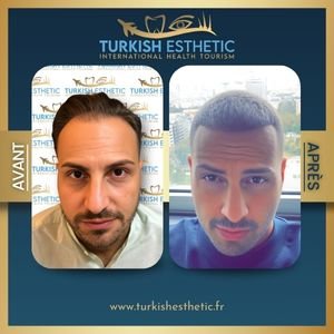 Transformation avant et après une greffe de cheveux réalisée chez Turkish Esthetic en Turquie, montrant une chevelure dense et naturelle.