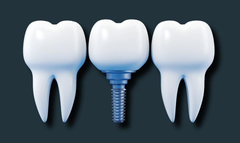 Exemple implant dentaire turquie