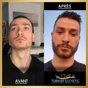 Résultat avant/après d'une greffe de barbe réalisée à Istanbul chez Turkish Esthetic sur un patient présentant une pilosité clairsemée.