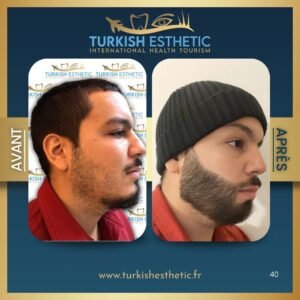 Résultat greffe de barbe en Turquie avant après – Turkish Esthetic à Istanbul