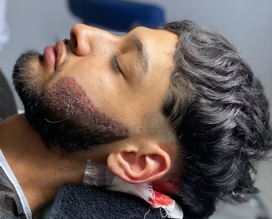 Photo post-opératoire d’un patient ayant subi une greffe de barbe à Istanbul chez Turkish Esthetic. Résultat immédiat visible.