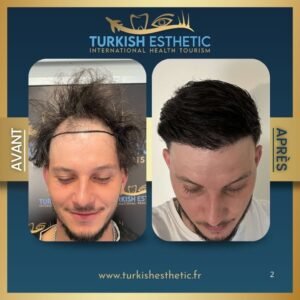 Résultat avant/après d'une greffe de cheveux en Turquie chez Turkish Esthetic : repousse dense et ligne frontale redessinée.