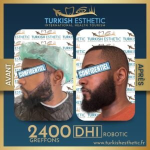 Résultat greffe de barbe DHI Robotic à Istanbul - 2400 greffons chez Turkish Esthetic